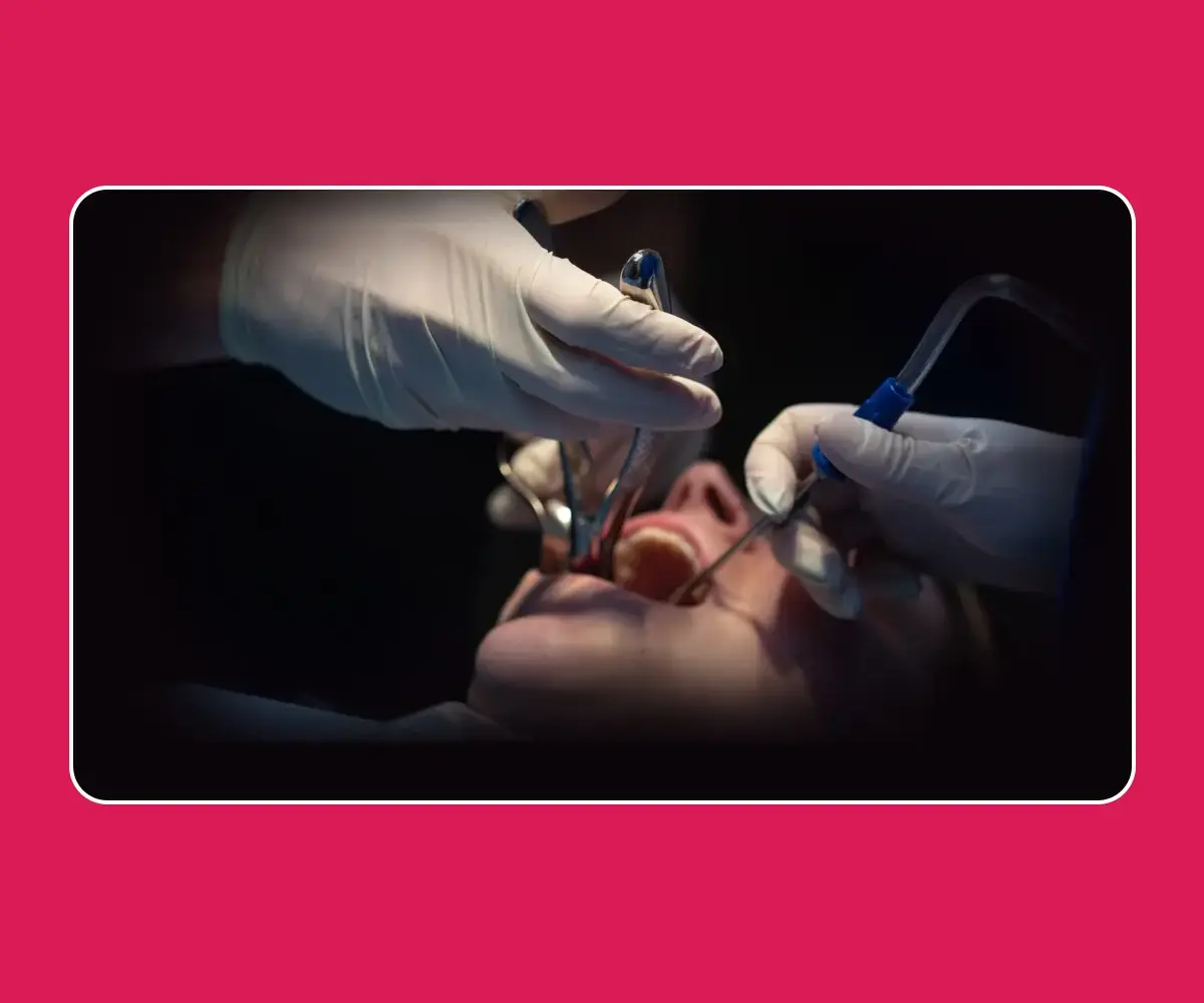 Wisdom Tooth Extraction in Gurgaon